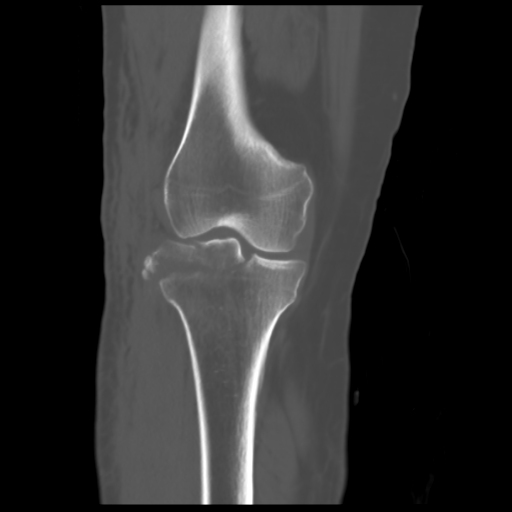 Tibial plateau fracture - Schatzker type IV | Image | Radiopaedia.org