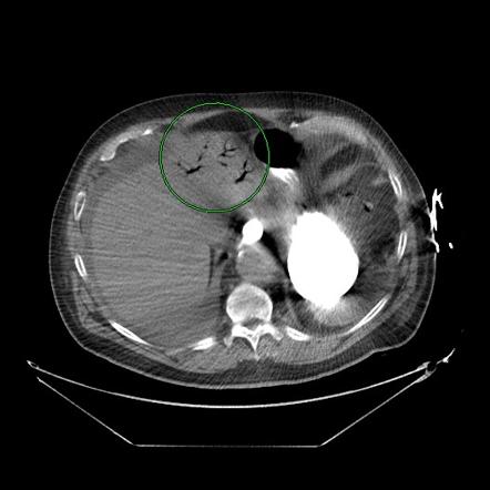 Portal venous gas | Radiology Case | Radiopaedia.org