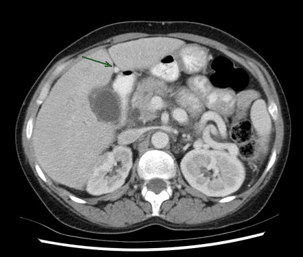 Portal venous hypertension | Radiology Case | Radiopaedia.org