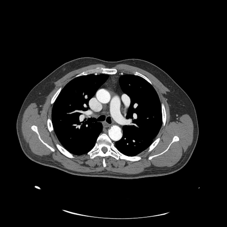 Levoatrial cardinal vein | Radiology Case | Radiopaedia.org