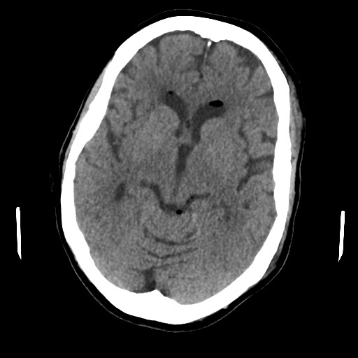 Ruptured Intracranial Dermoid Cyst Image 1396