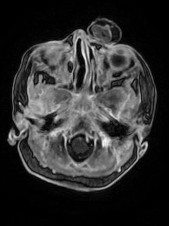 Nasal glioma | Radiology Reference Article | Radiopaedia.org