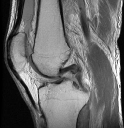 Posterior cruciate ligament tear | Radiology Case | Radiopaedia.org