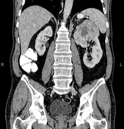 Renal cell carcinoma | Radiology Case | Radiopaedia.org