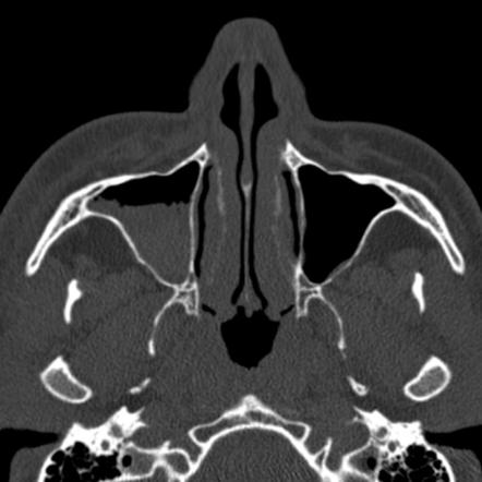 Orbital blowout fracture with inferior rectus entrapment | Image ...