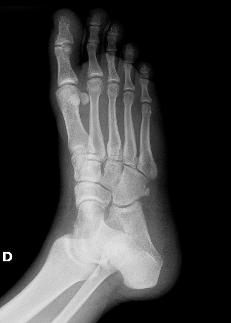 Accessory bones of the foot - os tibiale externum and os peroneum ...