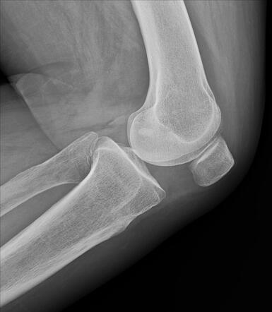 Lateral Collateral Ligament Calcification Knee Image Radiopaedia Org