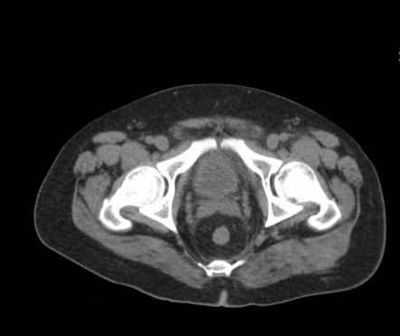 Burkitt lymphoma - muscle involvement | Radiology Case | Radiopaedia.org