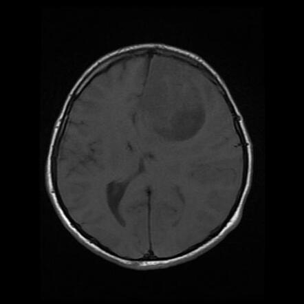 Pleomorphic xanthoastrocytoma | Radiology Case | Radiopaedia.org