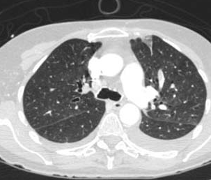 Pulmonary infarction | Image | Radiopaedia.org