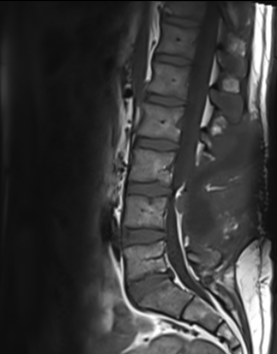 Postlaminectomy pseudomeningocele with nerve root entrapment | Image ...