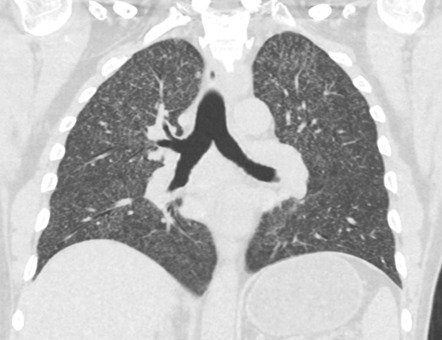 Disseminated tuberculosis | Radiology Case | Radiopaedia.org