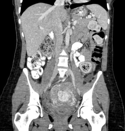 Retained products of conception | Image | Radiopaedia.org