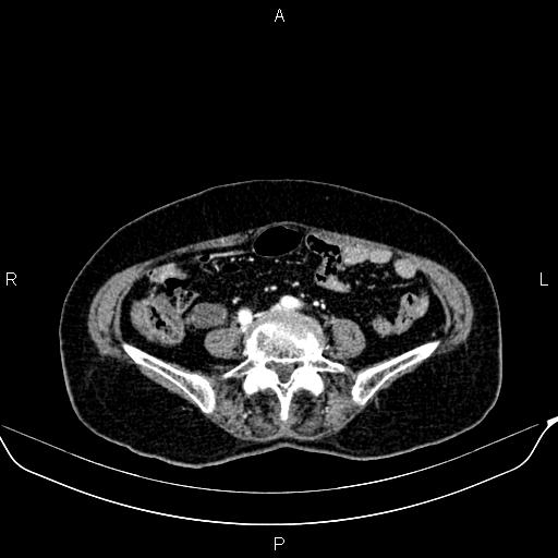 Appendiceal Mucocele | Image | Radiopaedia.org