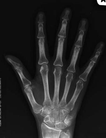 Rheumatoid Arthritis | Radiology Case | Radiopaedia.org