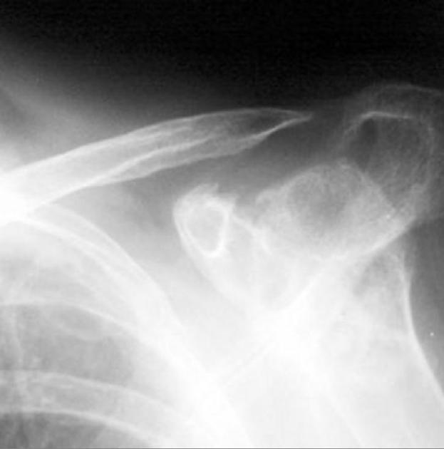 Distal clavicular erosion (differential)