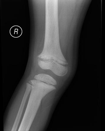 Rickets | Radiology Case | Radiopaedia.org