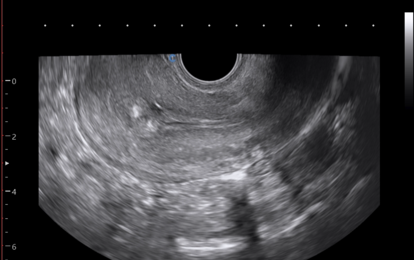 Endometrial polyp | Image | Radiopaedia.org