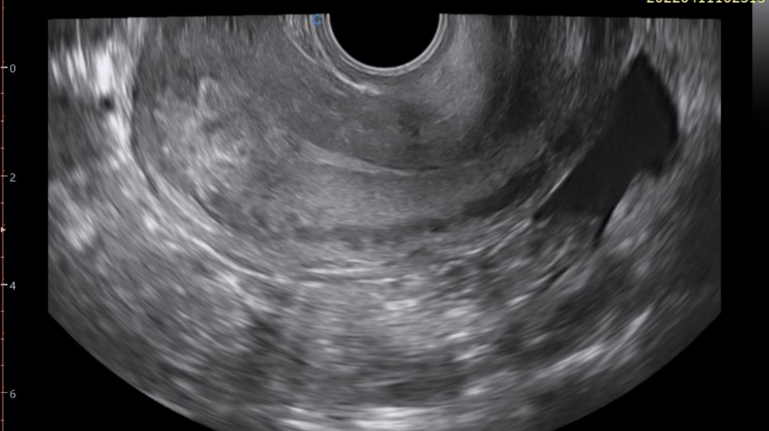 Endometrial polyp | Image | Radiopaedia.org