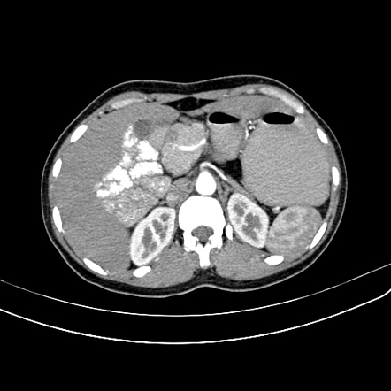 Dorsal pancreatic agenesis with bowel malrotation and polysplenia ...