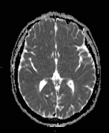 Radiation Induced Meningiomas And Cavernous Malformations 