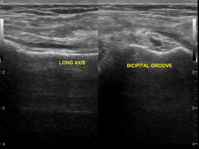 Acromioclavicular Joint Ganglion Radiology Case