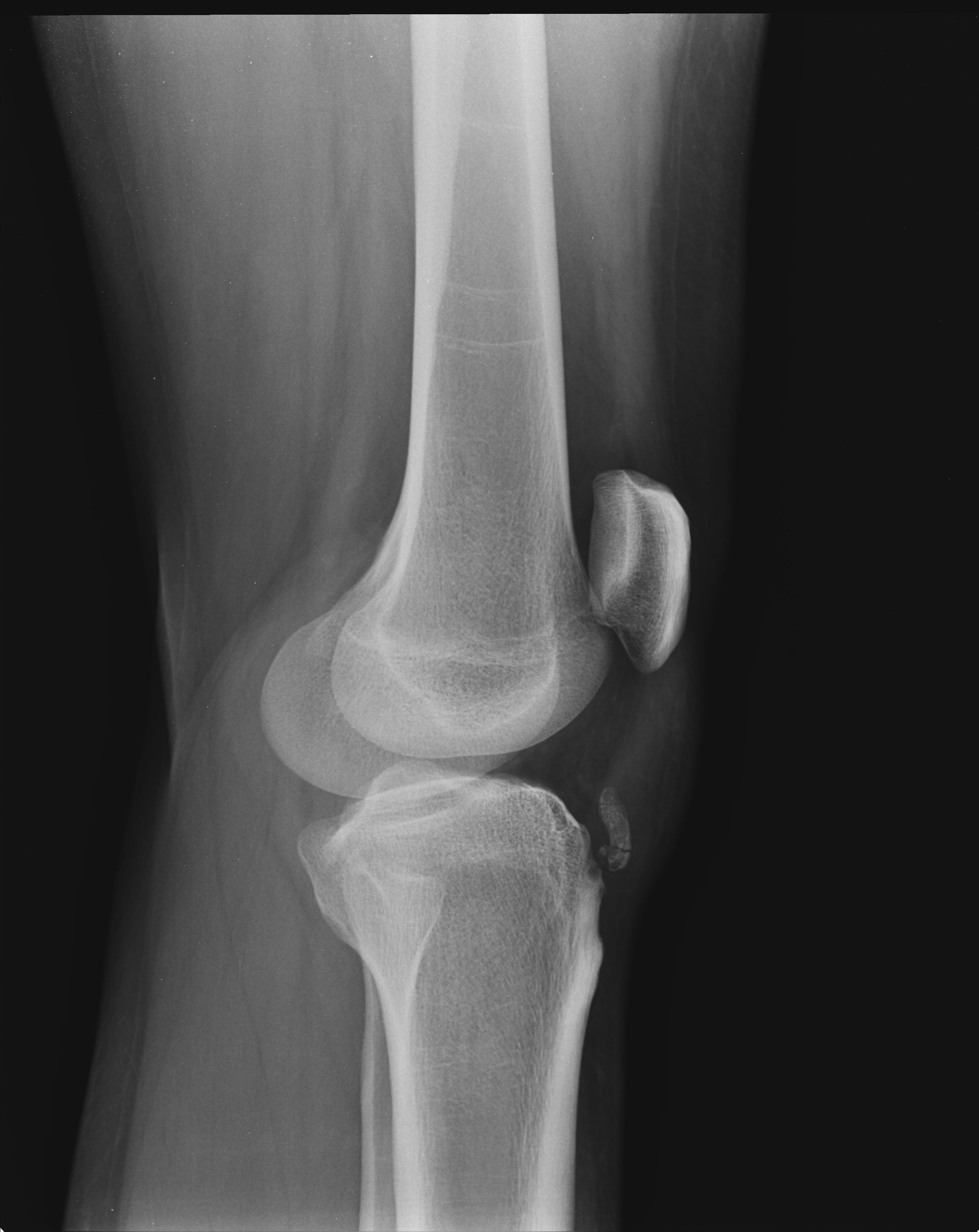 Patellar tendinosis | Image | Radiopaedia.org