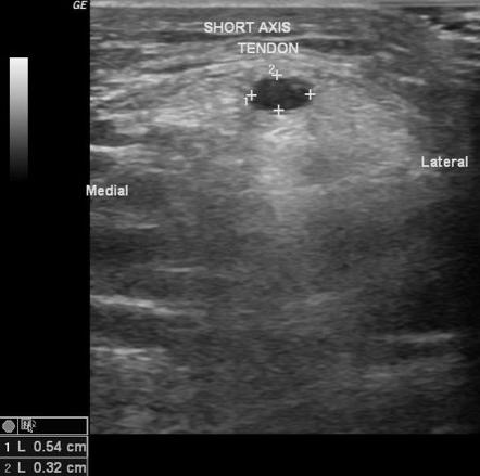 Patellar tendinosis | Image | Radiopaedia.org