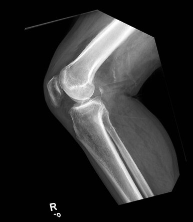 Hypertrophic osteoarthropathy | Image | Radiopaedia.org