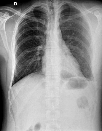 Pneumoperitoneum - small | Radiology Case | Radiopaedia.org