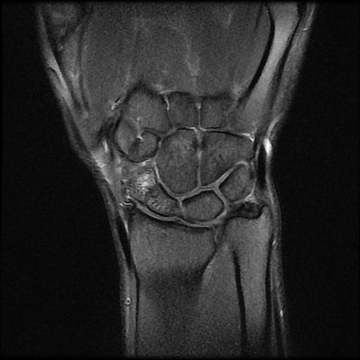 Avascular necrosis - scaphoid non-union | Image | Radiopaedia.org