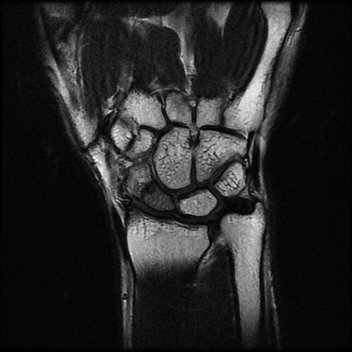 Avascular necrosis - scaphoid non-union | Image | Radiopaedia.org