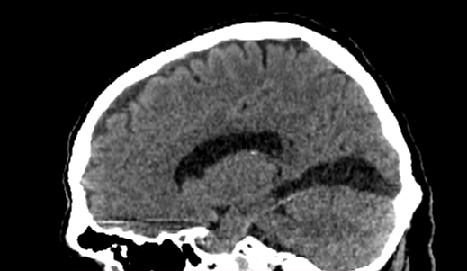 Encephalomalacia Right Occipital Lobe Image