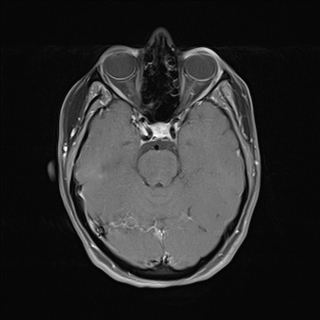 Cerebral cavernous venous malformation | Image | Radiopaedia.org