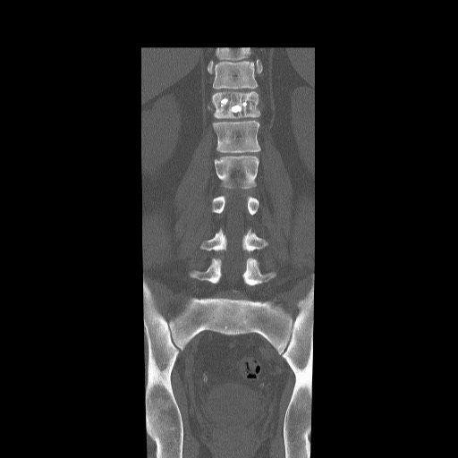 Bone Cement Vertebroplasty Image 2107