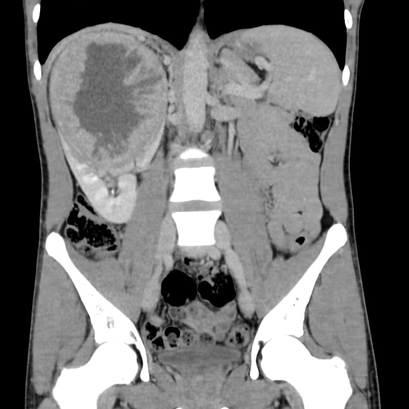 Clear Cell Renal Cell Carcinoma Image