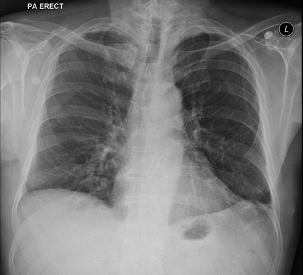 Bilateral lung transplant | Radiology Case | Radiopaedia.org