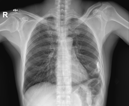 Pleural calcification | Radiology Case | Radiopaedia.org