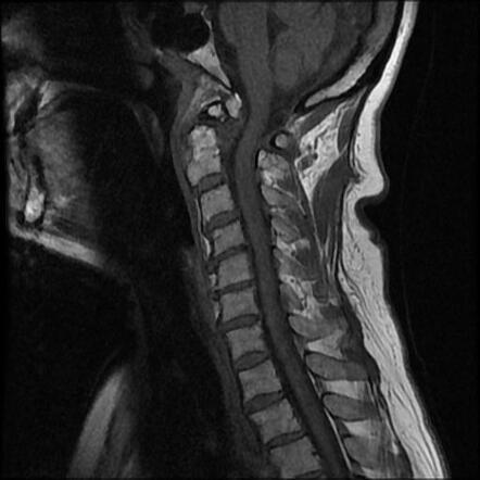 Chronic posterior atlantoaxial subluxation associated with os ...