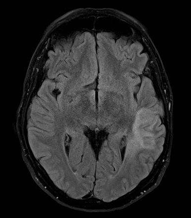 Subacute left MCA infarct | Image | Radiopaedia.org