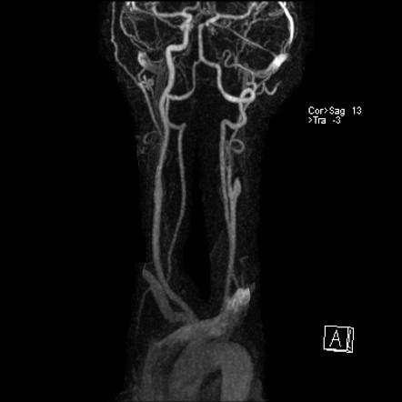 Subacute left MCA infarct | Image | Radiopaedia.org