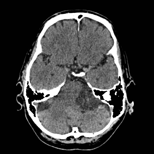 Cystic acoustic schwannoma | Image | Radiopaedia.org