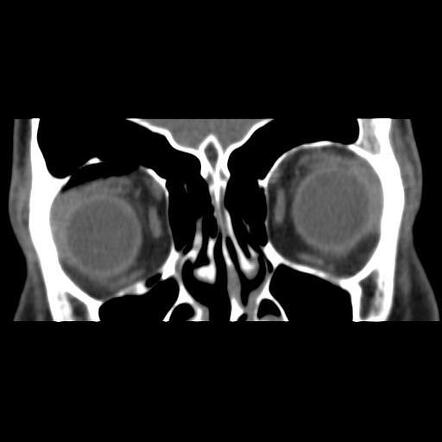 Orbital roof fracture | Radiology Case | Radiopaedia.org