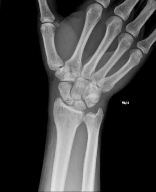 Scaphoid fracture | Radiology Reference Article | Radiopaedia.org