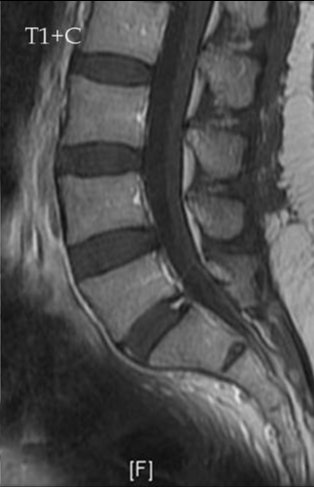 Annular Fissure L S Image Radiopaedia Org