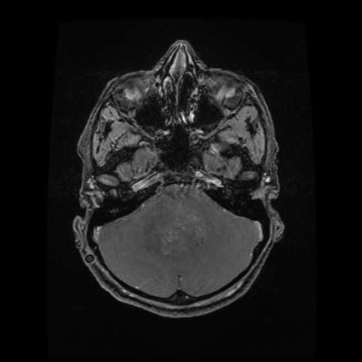 Medulloblastoma | Image | Radiopaedia.org