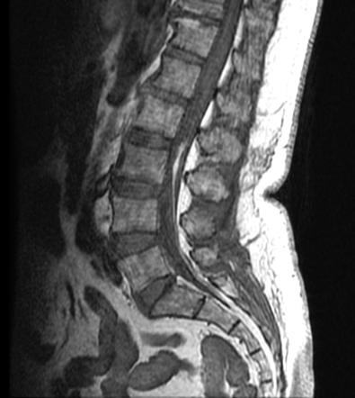 Fatty filum terminale | Radiology Case | Radiopaedia.org