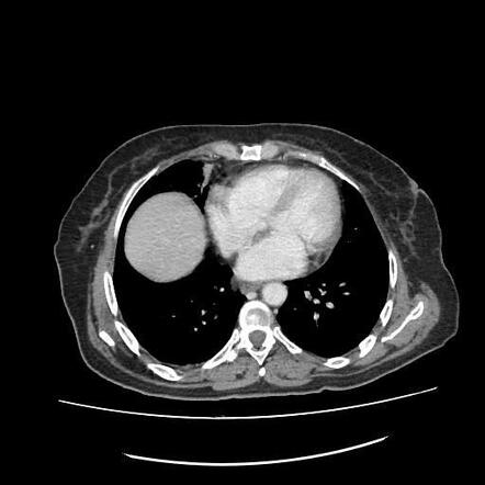 Accessory hemiazygos vein | Radiology Case | Radiopaedia.org