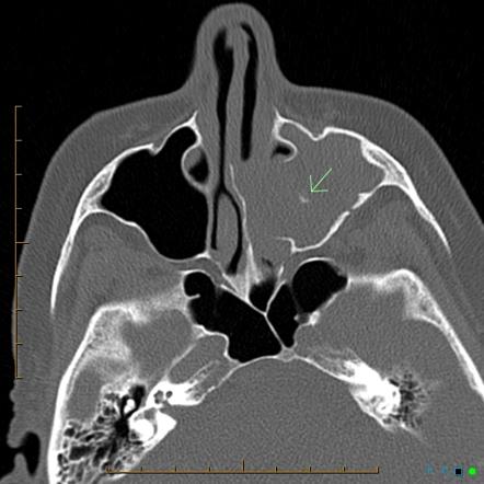 Chronic invasive fungal sinusitis with mycetoma | Image | Radiopaedia.org