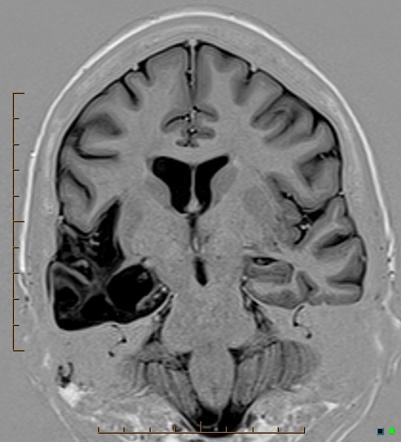 temporal lobe atrophy encephalitis herpes simplex radiopaedia coronal